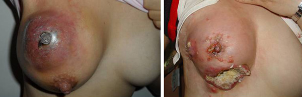rash between breast pictures #10