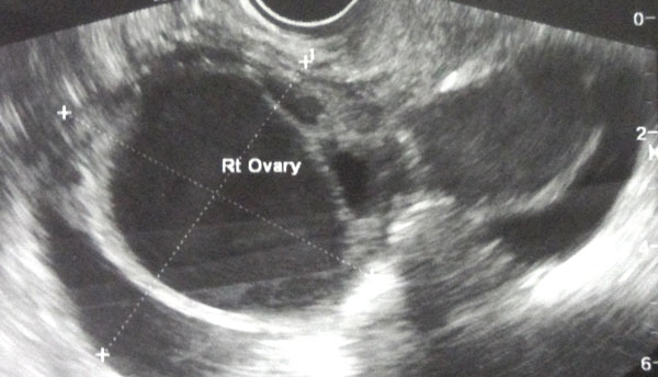 Can an ultrasound show the size of a cyst?